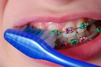 Braces Care - Orthodontist in Glastonbury, CT