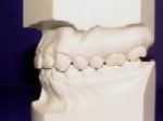 Class I - Malocclusion - Orthodontist in Glastonbury, CT