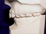 Class II - Malocclusion - Orthodontist in Glastonbury, CT