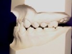 Class III - Malocclusion - Orthodontist in Glastonbury, CT