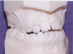 Crossbite - Occlusion - Orthodontist in Glastonbury, CT