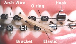 Orthodontic Terms - Orthodontist in Glastonbury, CT