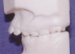 Overjet - Occlusion - Orthodontist in Glastonbury, CT